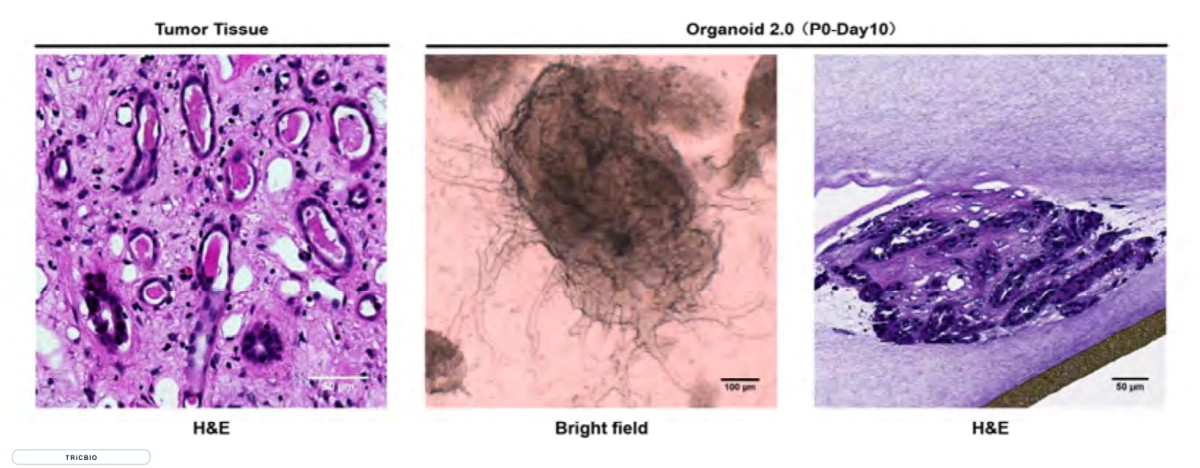 Tumor tissue, PDO bright-field and PDO H&E